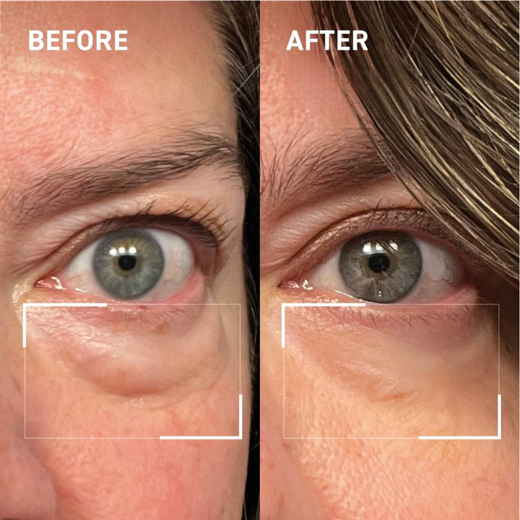 Lid Lifting Treatment