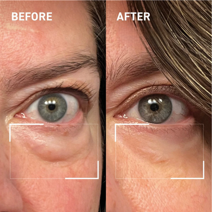 Lid Lifting Treatment